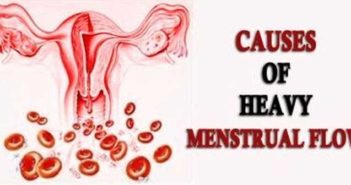 Heavy Menstrual Bleeding Period