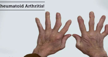 Arthritis-Causes